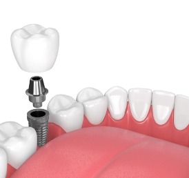 Calgary Dental Implants | Shawnessy Smile Dental