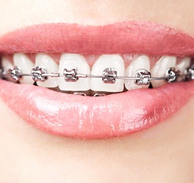 Dental Braces Calgary | Shawnessy Smile Dental