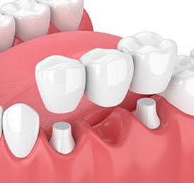 Dental Bridges Services Calgary | Shawnessy Smile Dental
