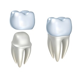 Dental Crown Calgary | Shawnessy Smile Dental