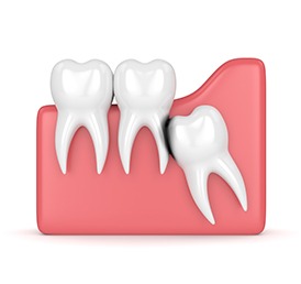 Wisdom Teeth Extraction Calgary | Shawnessy Smile Dental
