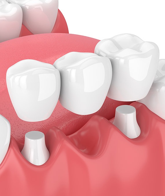 How Calgary Dental Bridges Work | Shawnessy Smile Dental