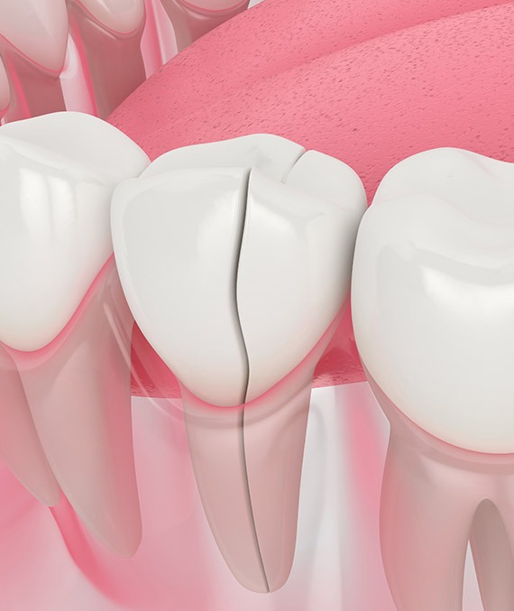 Southwest Calgary Dental Crowns | Shawnessy Smile Dental