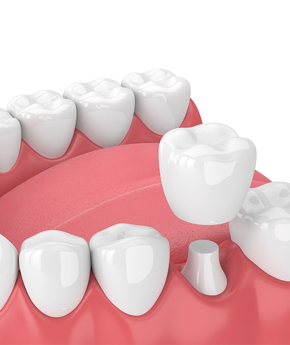 Dental Crowns in Calgary AB | Shawnessy Smile Dental