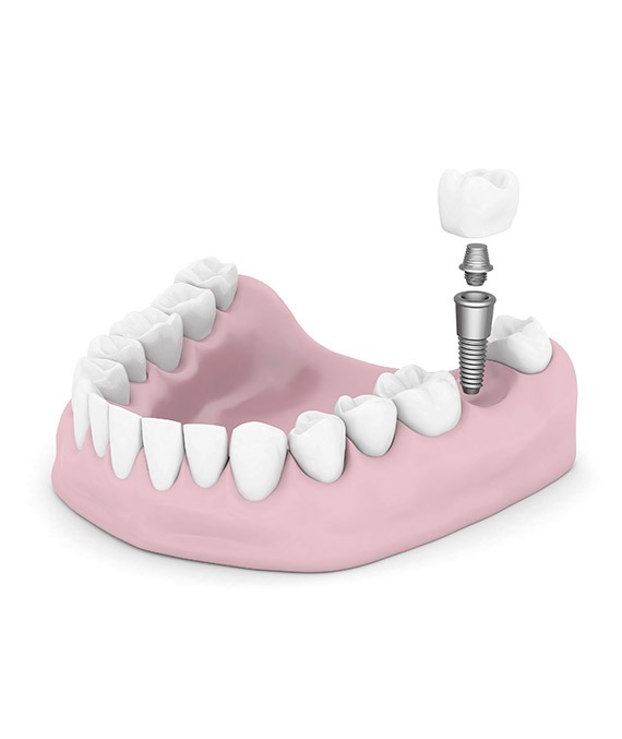 What is a Dental Implant Calgary | Shawnessy Smile Dental