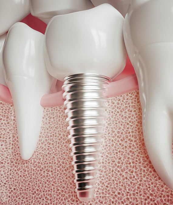 South Calgary Dental Implants | Shawnessy Smile Dental