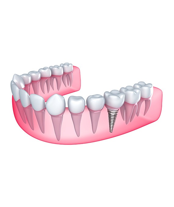 Dental Implants SW Calgary | Shawnessy Smile Dental