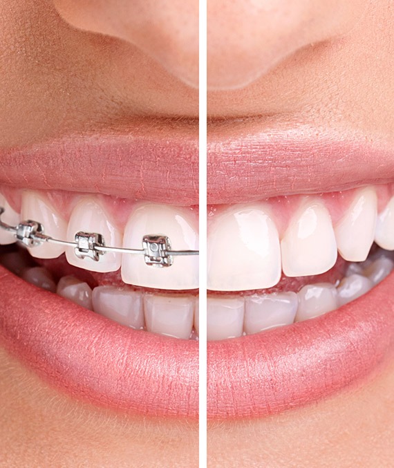 Benefits of Orthodontic Treatment in Calgary AB | Shawnessy Smile Dental