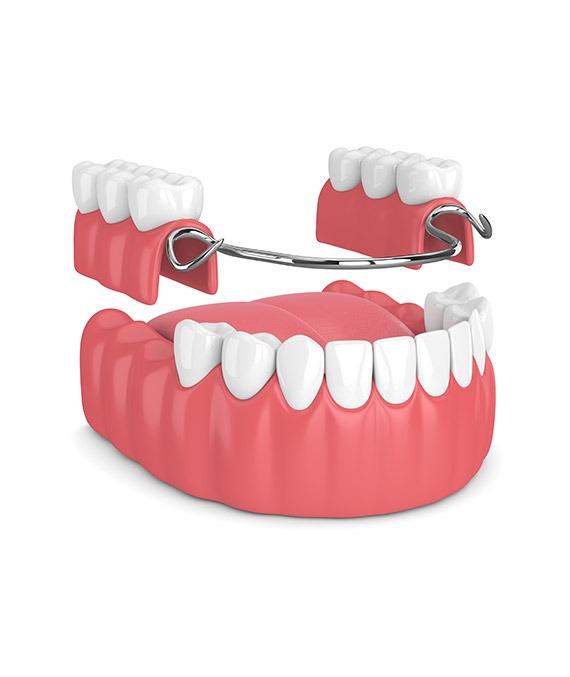 Partial Dentures Treatment Calgary | Shawnessy Smile Dental Clinic