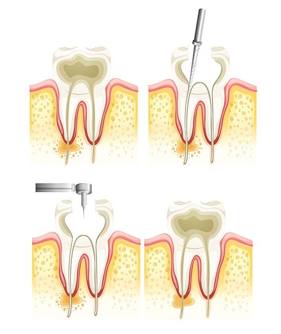 What is Root Canal Therapy and Why might you Need it? | Shawnessy Smile