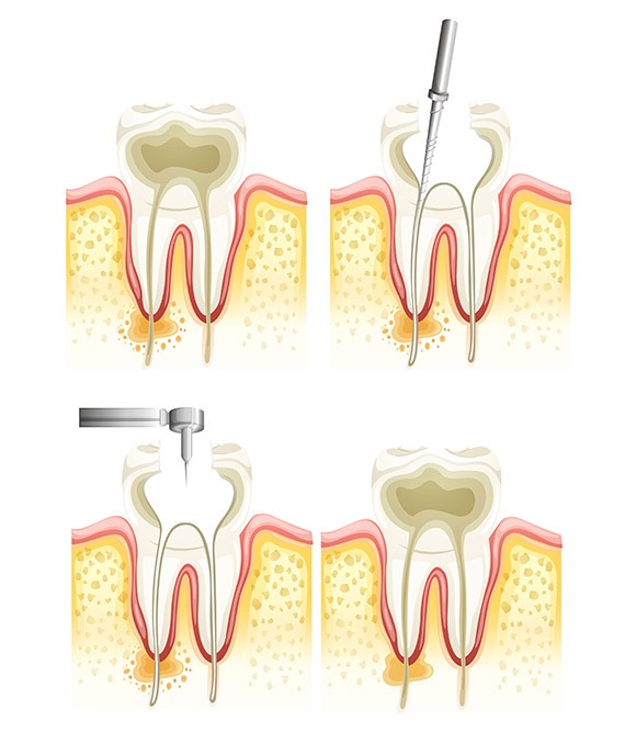 What is Root Canal Therapy and Why might you Need it? | Shawnessy Smile