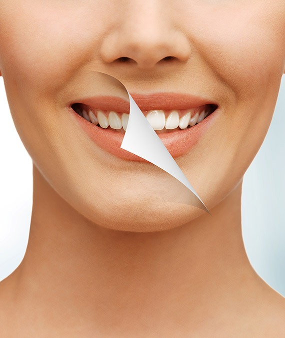 Southwest Calgary Teeth Whitening | Shawnessy Smile Dental