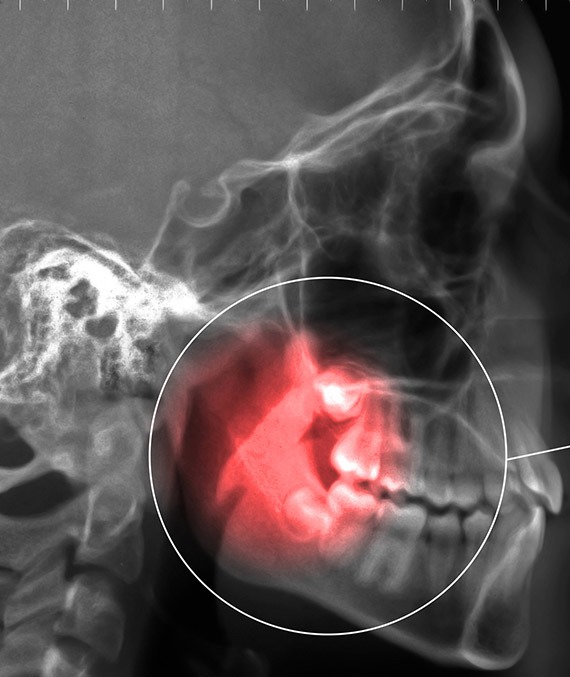 Southwest Wisdom Teeth Extractions | Shawnessy Smile Dental