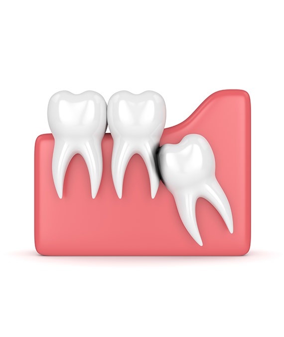 Wisdom teeth removal Calgary | Shawnessy Smile Dental